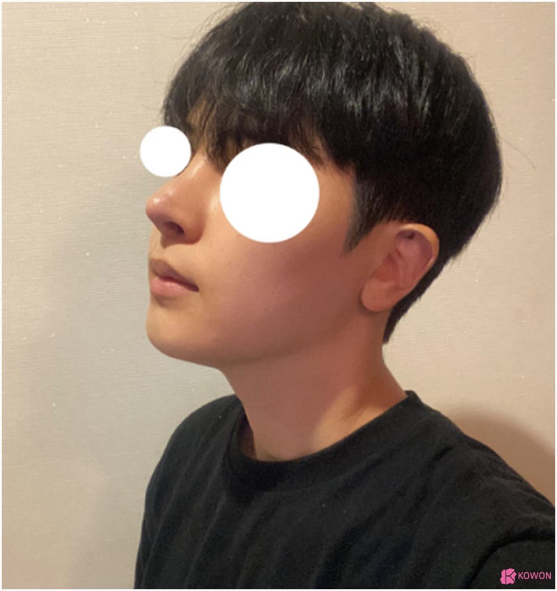 코수술 콧구멍 짝짝이 들림 개선 코수술재수술 사진 11
