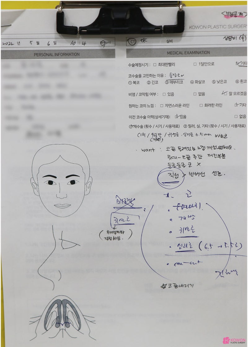 코수술 콧구멍 짝짝이 들림 개선 코수술재수술