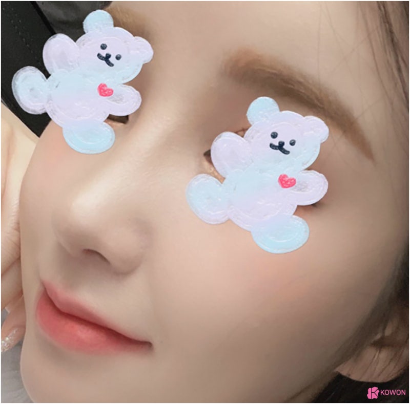 복코 코끝성형 압구정코성형외과 이미지 콧대 인상 비염 사진 7