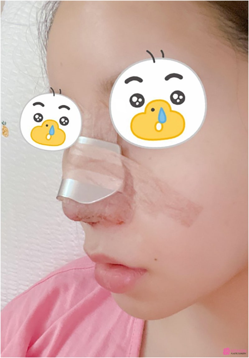 복코 코끝성형 압구정코성형외과 이미지 콧대 인상 비염 사진 5