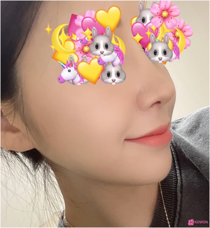 복코 코끝성형 압구정코성형외과 이미지 콧대 인상 비염 사진 9