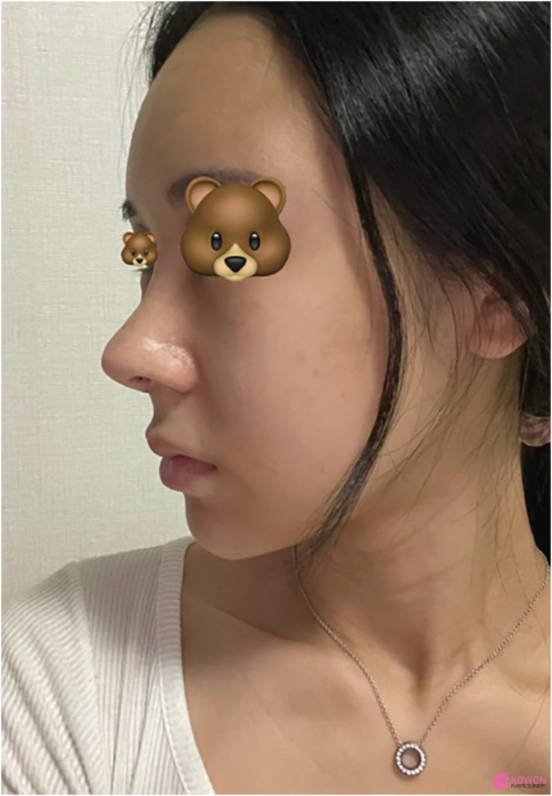 신사역코성형외과 코끝재수술후기 알레르기 항생제 회복 과정 사진 6