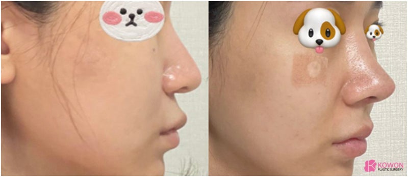 신사역코성형외과 코끝재수술후기 알레르기 항생제 회복 과정 사진 10
