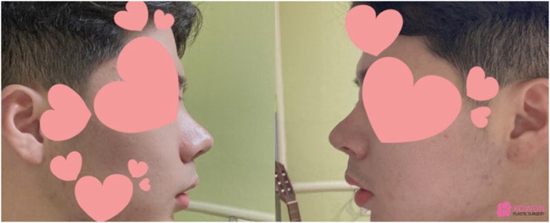 압구정역성형외과 남자복코 개선 자가 늑연골 변화 모양 특징 사진 6