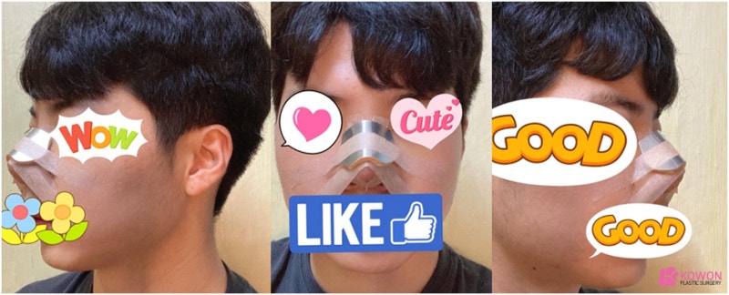 압구정역성형외과 남자복코 개선 자가 늑연골 변화 모양 특징 사진 4