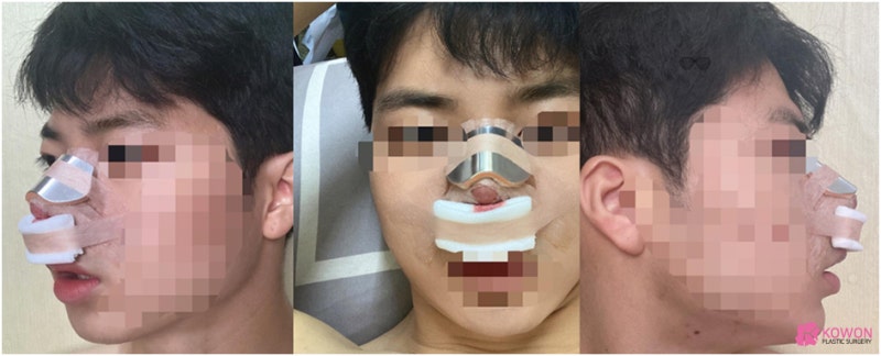 압구정역성형외과 남자복코 개선 자가 늑연골 변화 모양 특징 사진 3