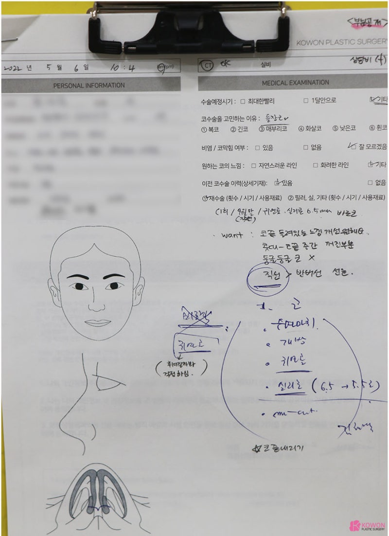 돼지코성형 비주 콤플렉스 개선 남자 코끝 내리기
