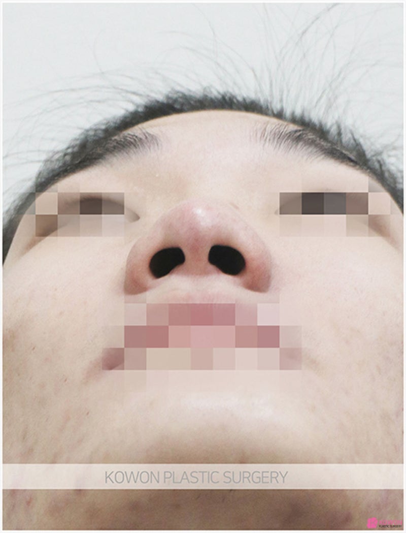코폭축소 사례 비염 코끝퍼짐 넓고 둥근 모양 개선 사진 5