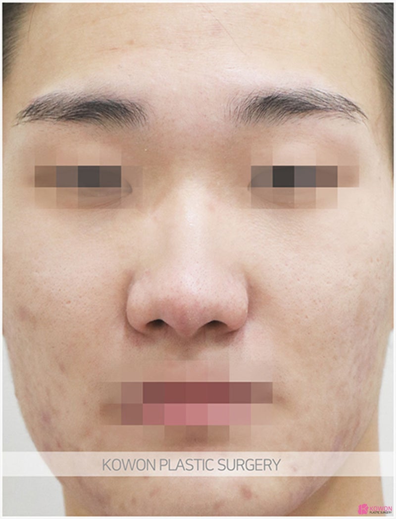 코폭축소 사례 비염 코끝퍼짐 넓고 둥근 모양 개선 사진 3