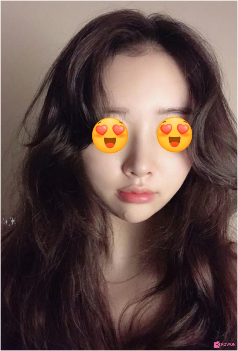 미간 콧대 수술 여자 코높이기 콤플렉스 해결 사진 8