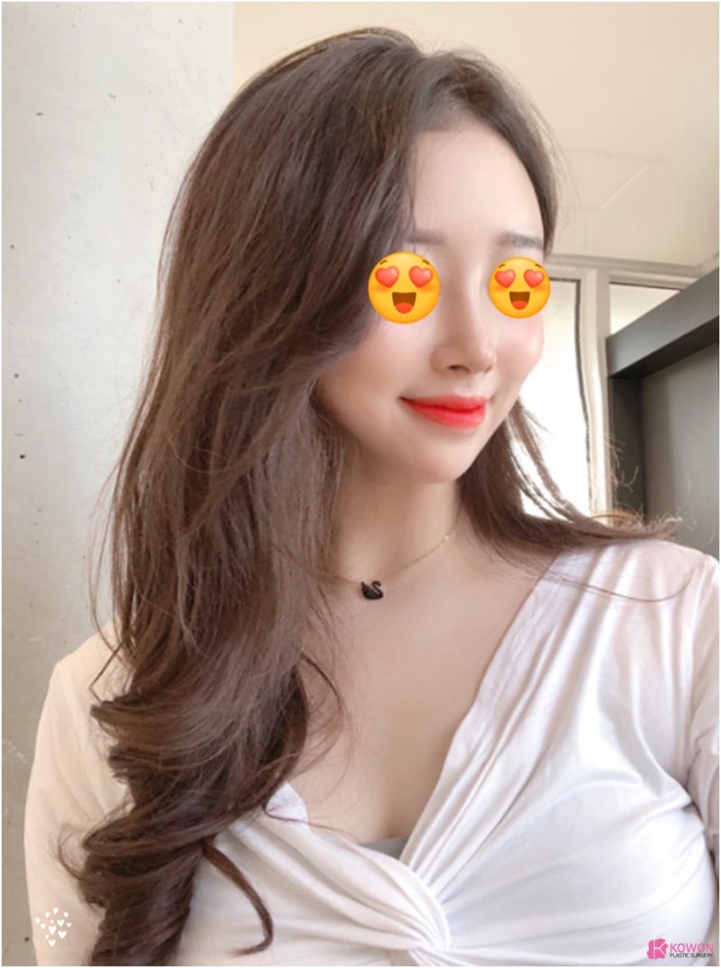 미간 콧대 수술 여자 코높이기 콤플렉스 해결 사진 5