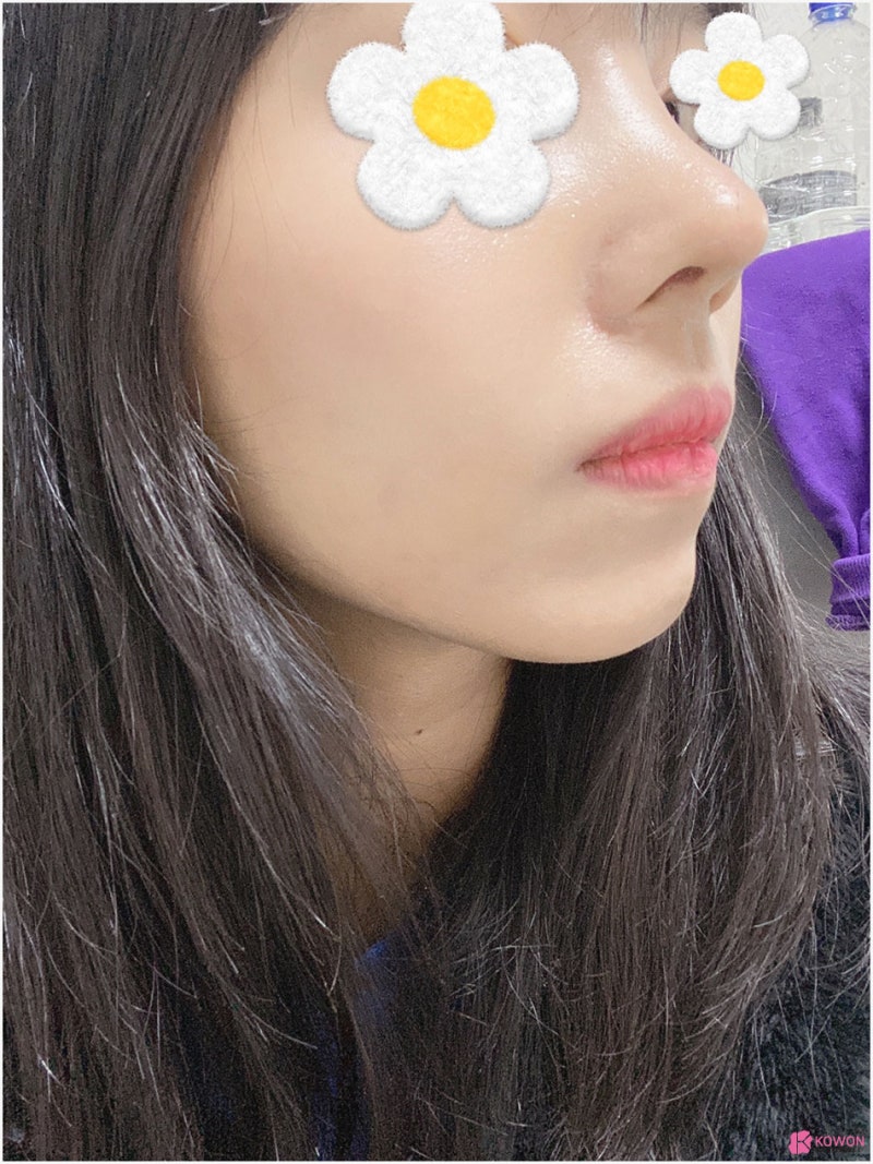매부리코성형후기 콧등 돌출 마녀코 모양 변화 사진 10