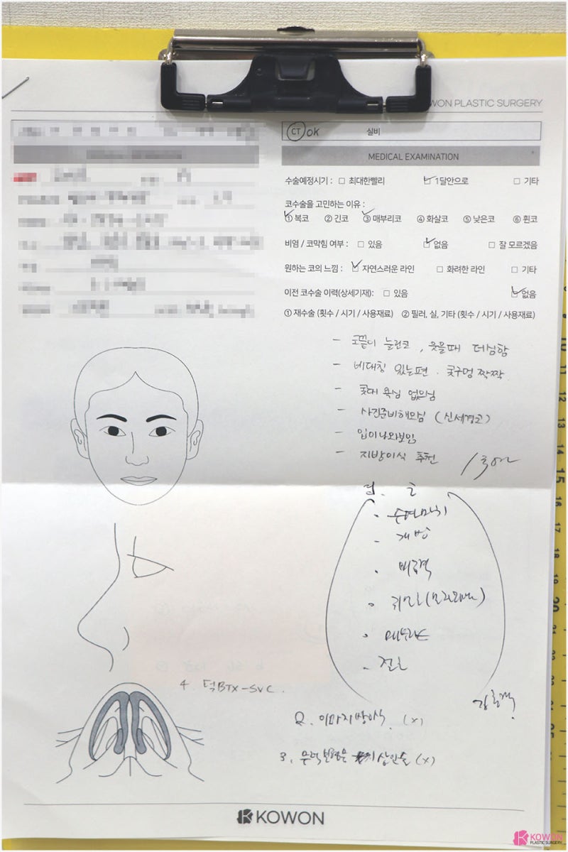 매부리코성형후기 콧등 돌출 마녀코 모양 변화