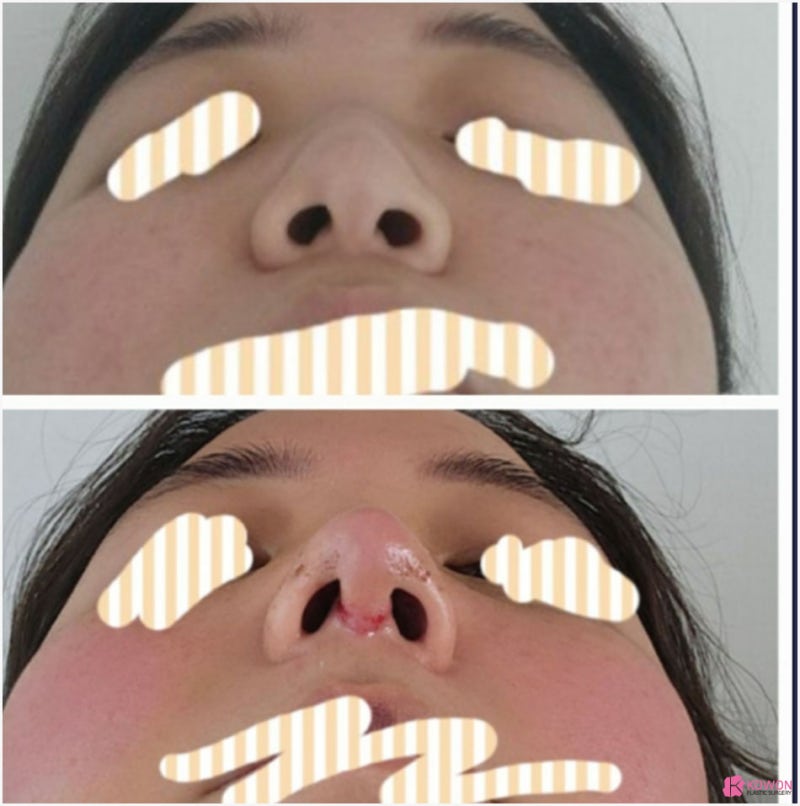 복코성형 전후 회복 코끝높이 따른 이미지 변화 사진 13