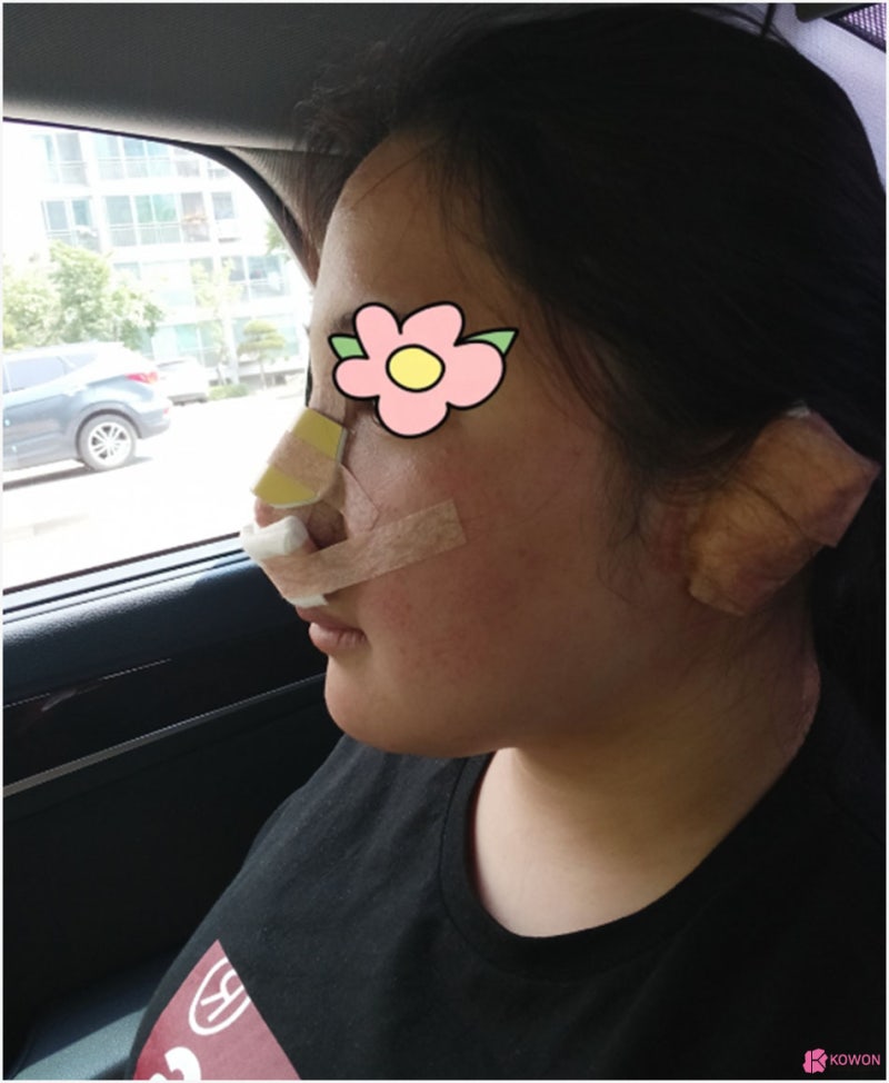 복코성형 전후 회복 코끝높이 따른 이미지 변화 사진 8