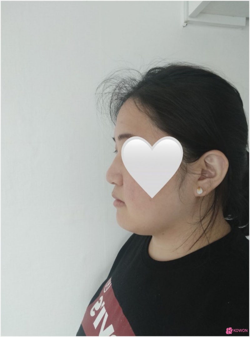 복코성형 전후 회복 코끝높이 따른 이미지 변화 사진 4