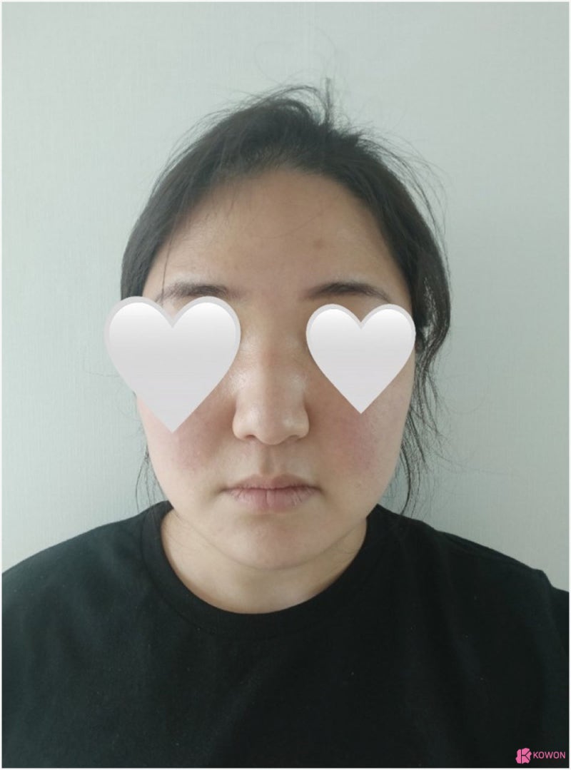 복코성형 전후 회복 코끝높이 따른 이미지 변화 사진 5