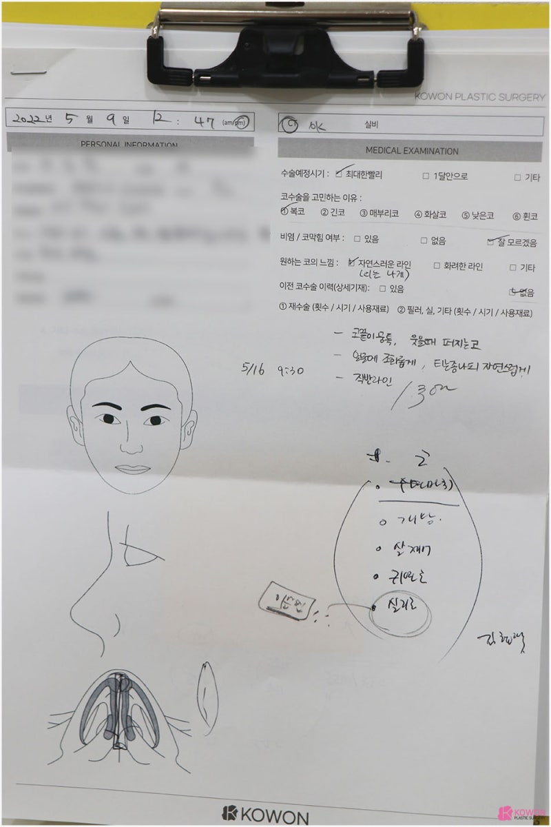 복코성형 전후 회복 코끝높이 따른 이미지 변화
