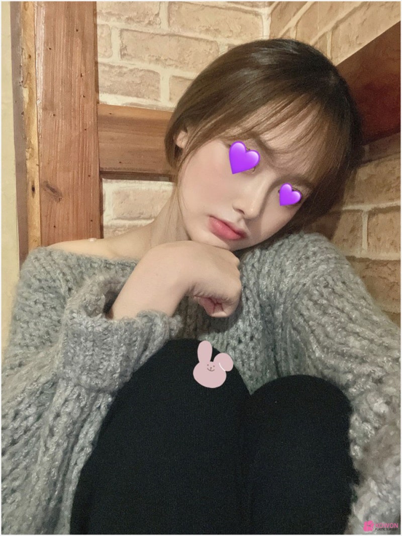 코끝리프팅 효과 처진 코 수술 강남구청역성형외과 사진 10