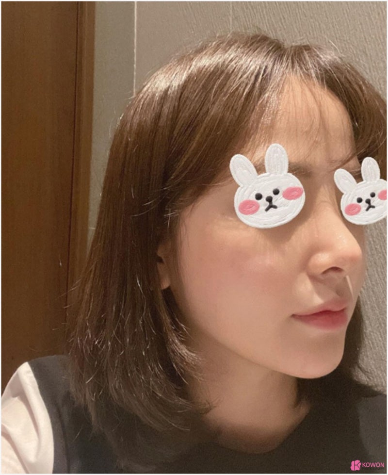 강남신사성형외과 코필러제거 후 자연스러운 결과 사진 6