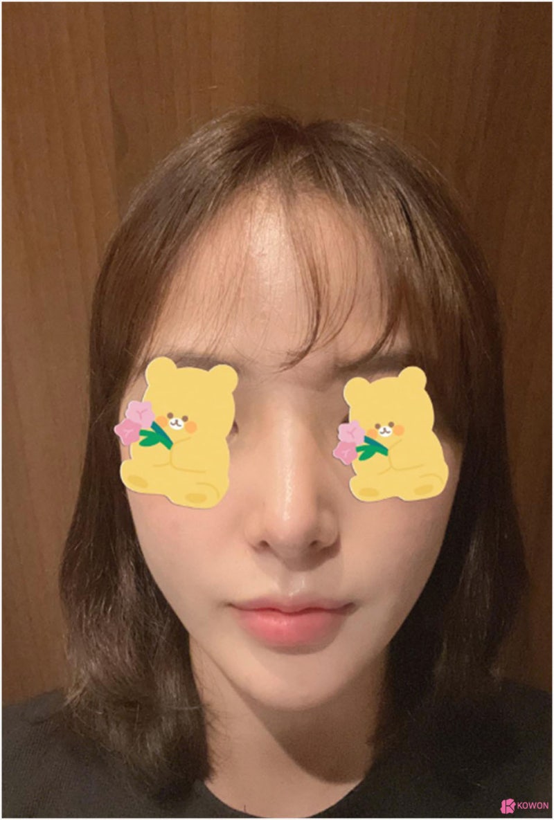 강남신사성형외과 코필러제거 후 자연스러운 결과 사진 8