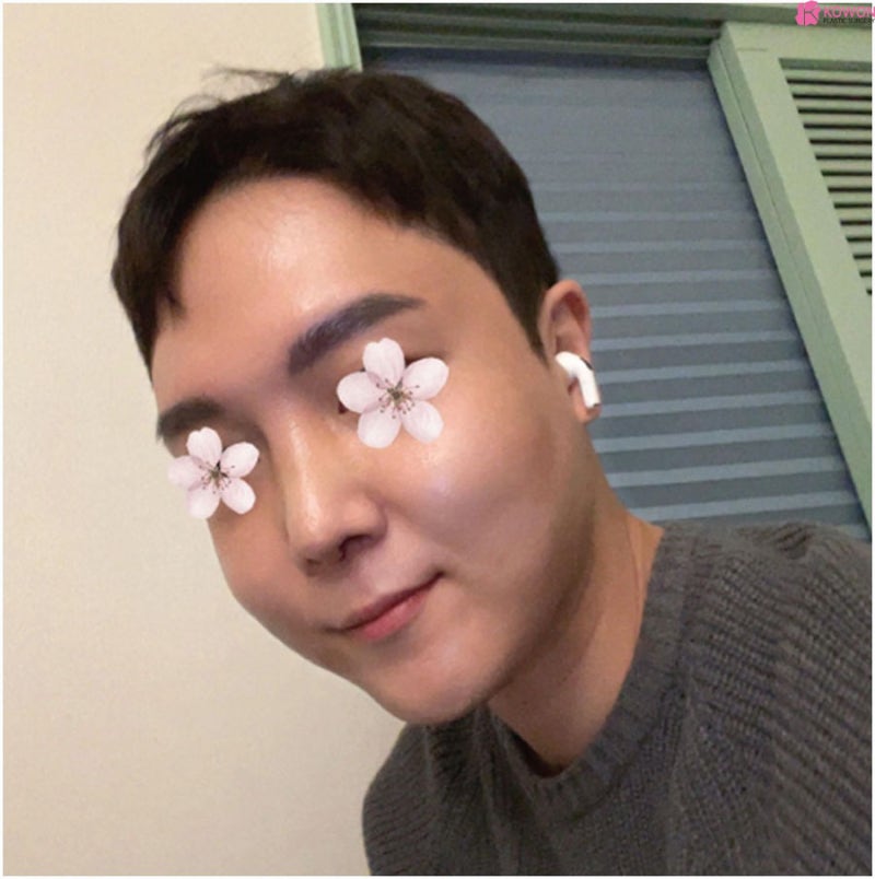 코성형외과추천 코끝구축 부작용 남자 들창코 개선 사진 6