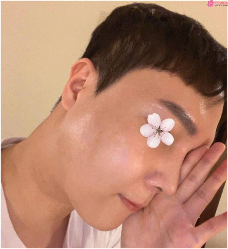 코성형외과추천 코끝구축 부작용 남자 들창코 개선 사진 8