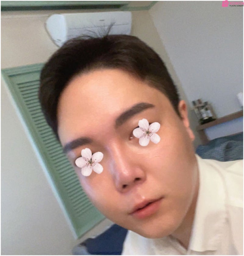 코성형외과추천 코끝구축 부작용 남자 들창코 개선 사진 3