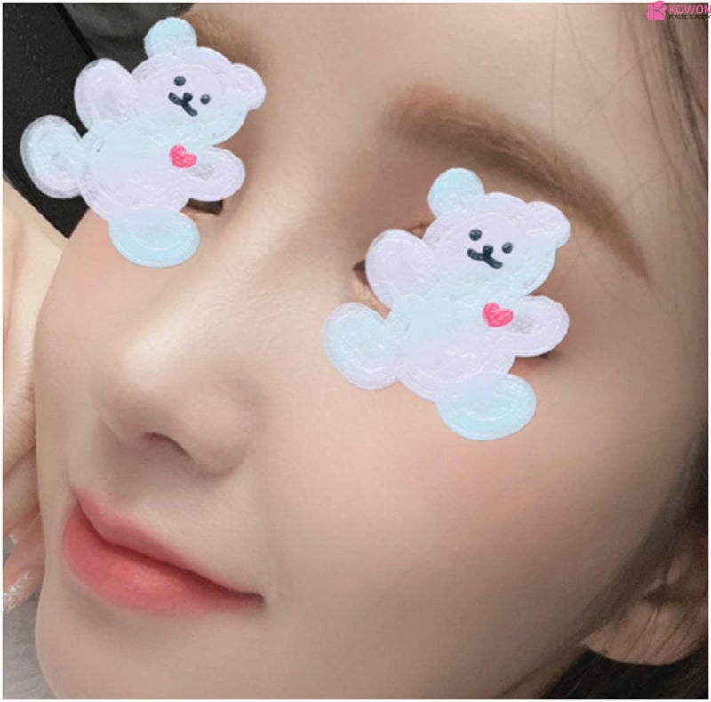 낮은코 휘어진 비중격 교정 기능코성형외과 사진 8