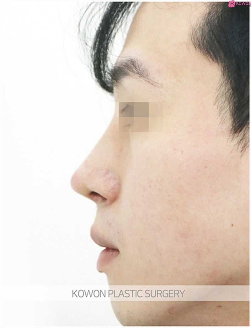 코끝성형외과 매끄러운 콧대 남자매부리코수술 사진 9