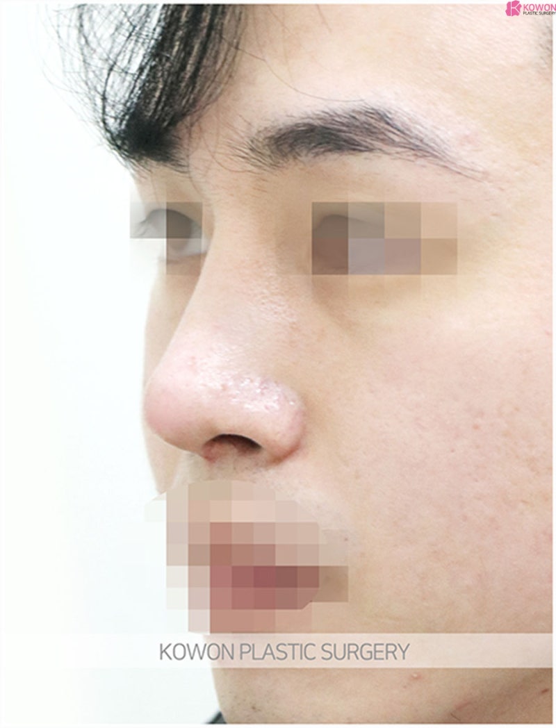 코끝성형외과 매끄러운 콧대 남자매부리코수술 사진 4