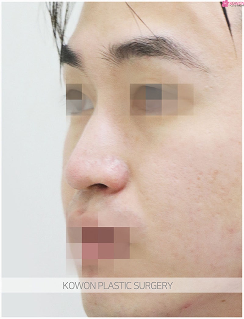 코끝성형외과 매끄러운 콧대 남자매부리코수술 사진 3