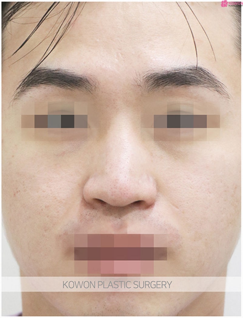 코끝성형외과 매끄러운 콧대 남자매부리코수술 사진 5