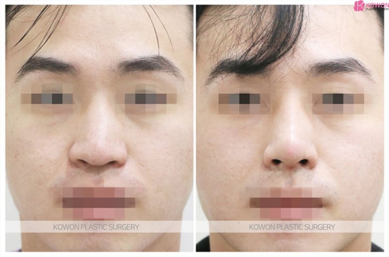 코끝성형외과 매끄러운 콧대 남자매부리코수술 사진 11