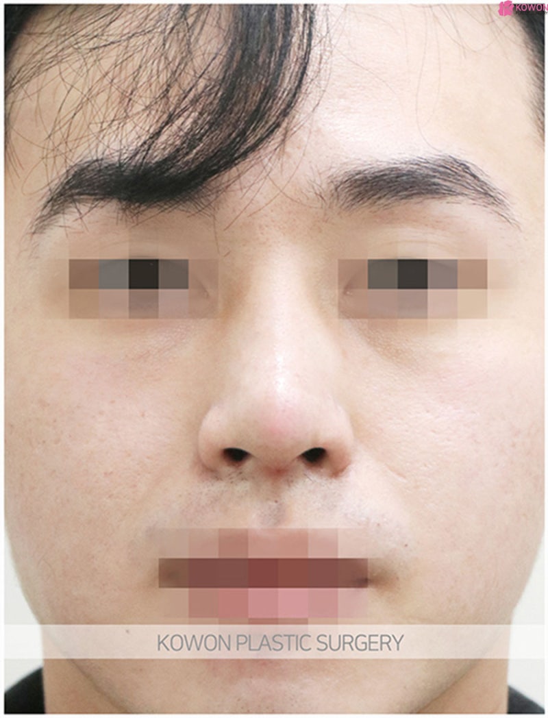 코끝성형외과 매끄러운 콧대 남자매부리코수술 사진 6