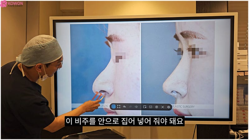 코비주 ACR 관계 연관성 각도 모양 길이 비주성형 특징 사진 7