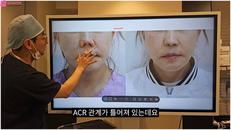 코비주 ACR 관계 연관성 각도 모양 길이 비주성형 특징 사진 5