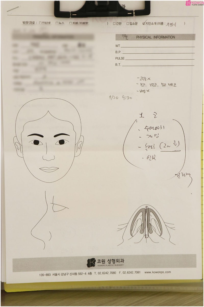 남자코성형외과 콧볼수술 두꺼운 피부 납작한 모양 콤플렉스 해결