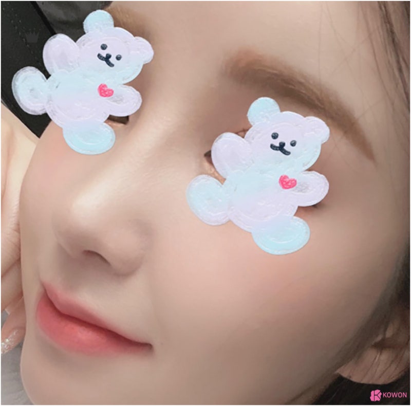 복코수술후기 결혼전성형 사례 이미지 후기 실리콘 관리 사진 8