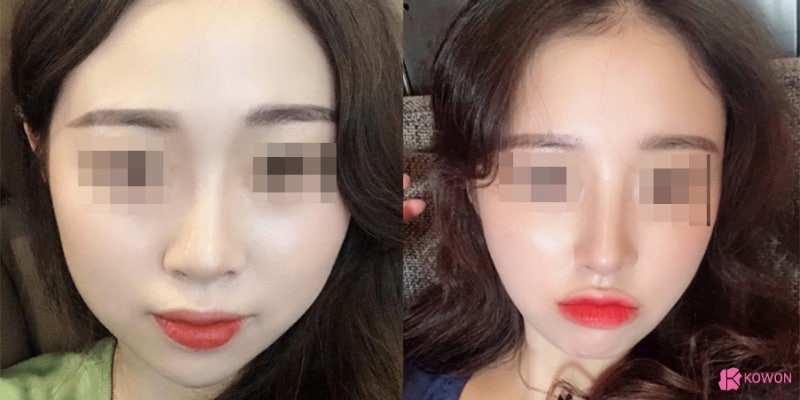 압구정동성형외과 작은코성형 형태 느낌 선호 구조 지방이식 사진 11