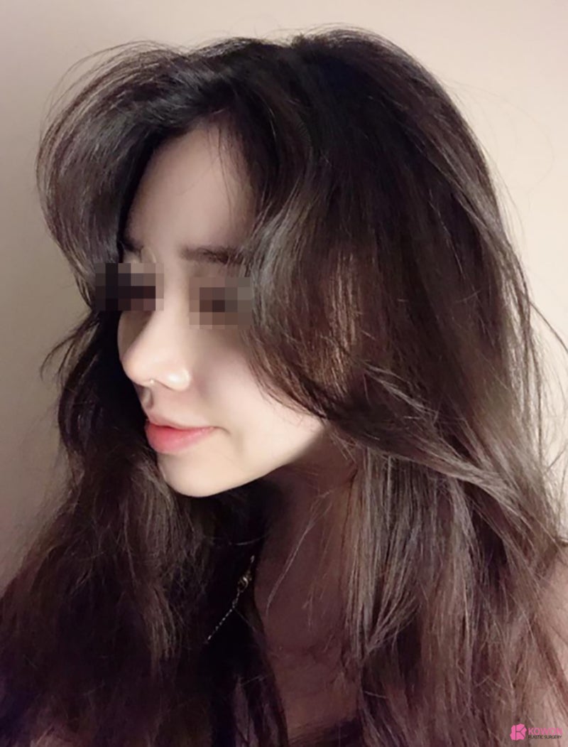압구정동성형외과 작은코성형 형태 느낌 선호 구조 지방이식 사진 5