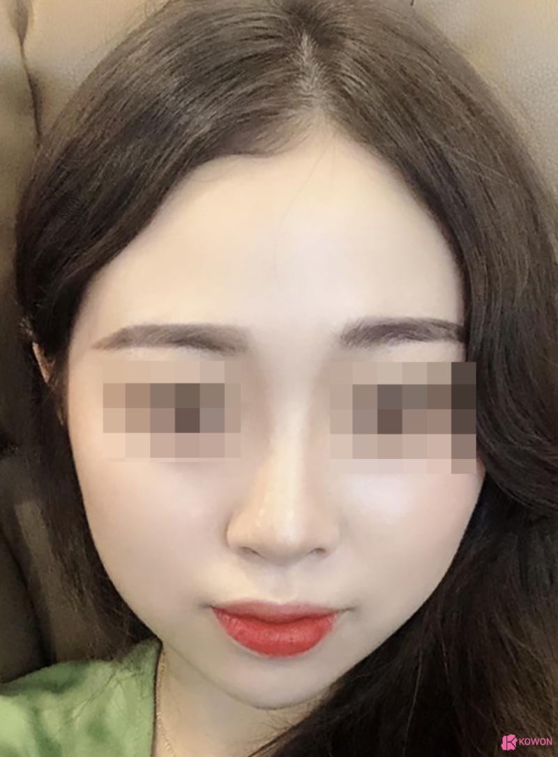 압구정동성형외과 작은코성형 형태 느낌 선호 구조 지방이식 사진 4