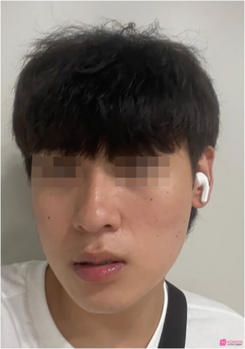 코다이어트 남자콧대성형 디자인 부기 문의 시기 관리 비염 사진 3