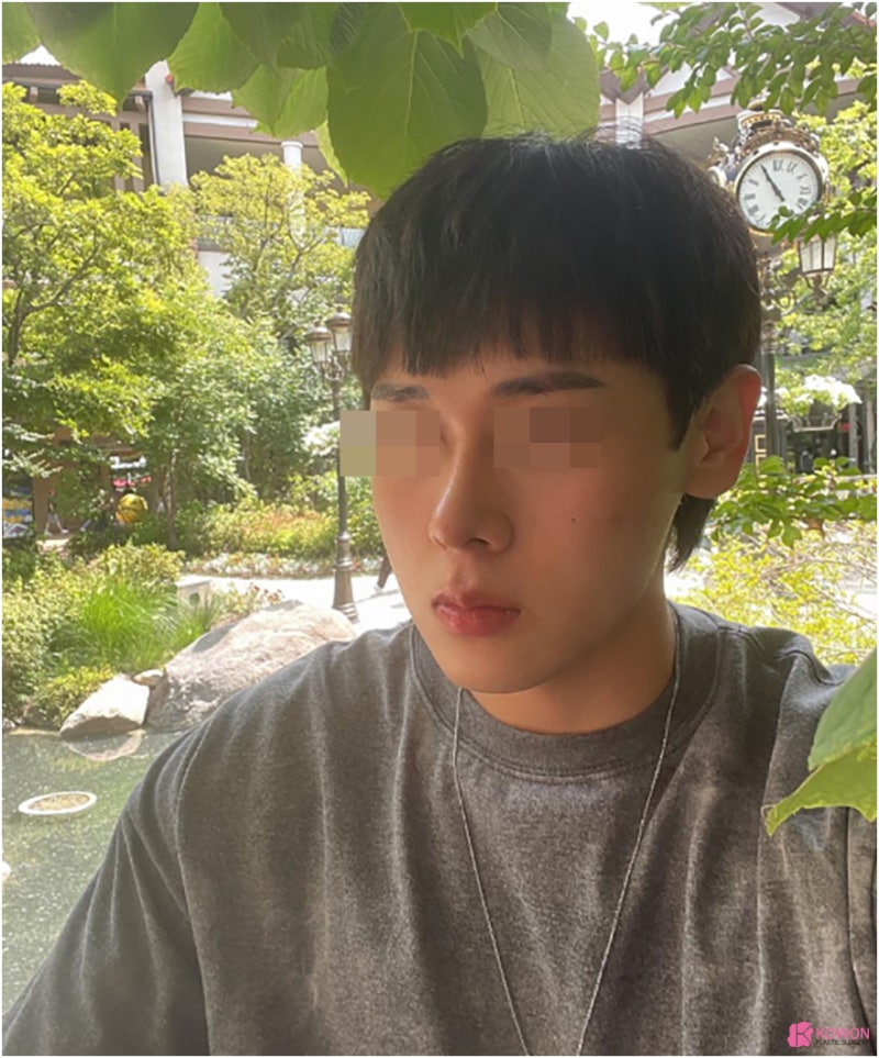 코다이어트 남자콧대성형 디자인 부기 문의 시기 관리 비염 사진 9