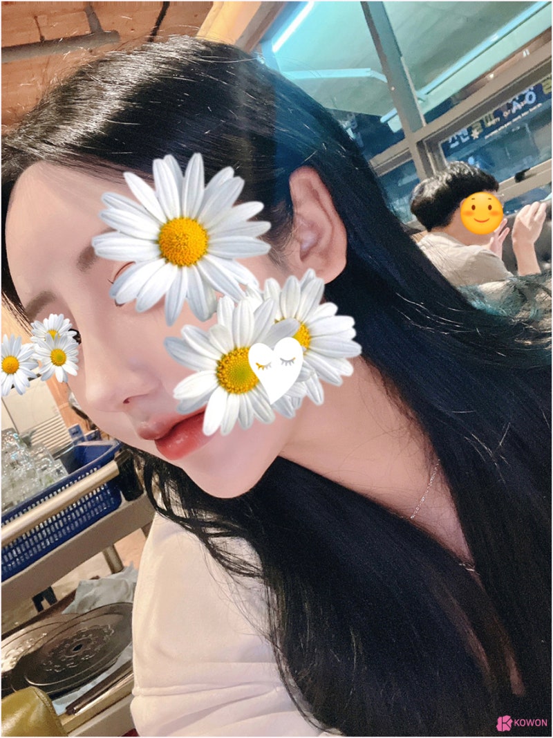 반포성형외과 얼굴 조화 자가늑연골수술 코끝 디자인 사진 6