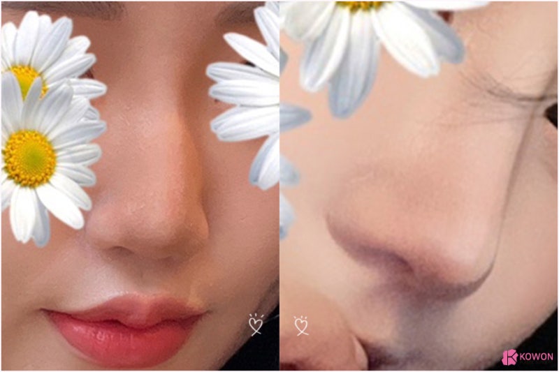 반포성형외과 얼굴 조화 자가늑연골수술 코끝 디자인 사진 11