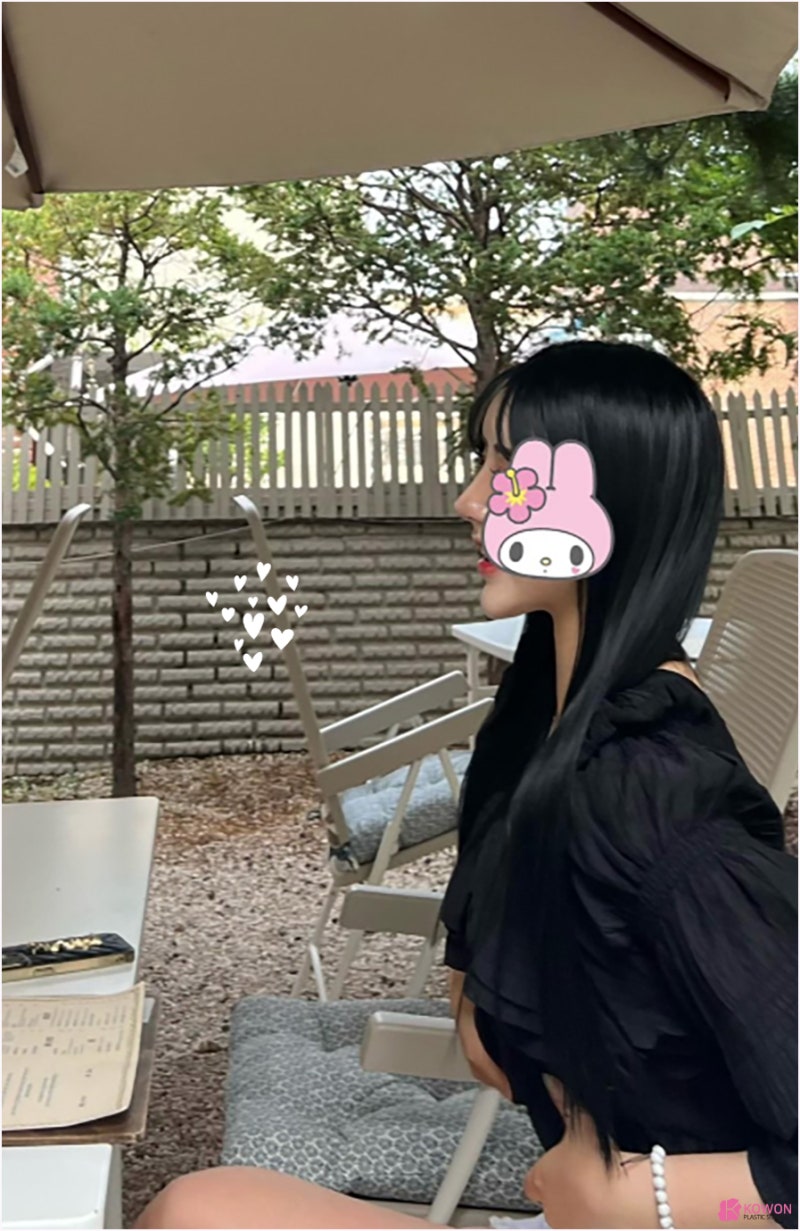 반포성형외과 얼굴 조화 자가늑연골수술 코끝 디자인 사진 8
