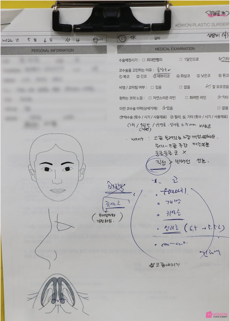 신사동성형외과 코끝 비대칭 개선 남자코재수술