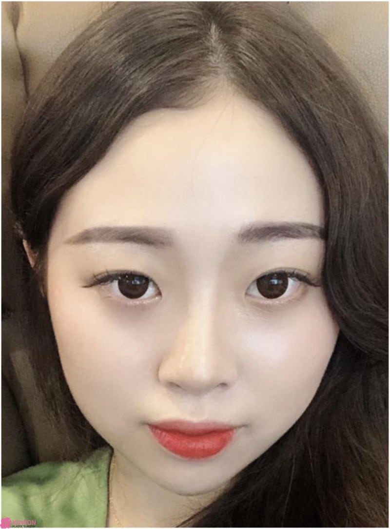 낮은코수술방법 여성스러운 이미지 변화 청담역성형외과 사진 4