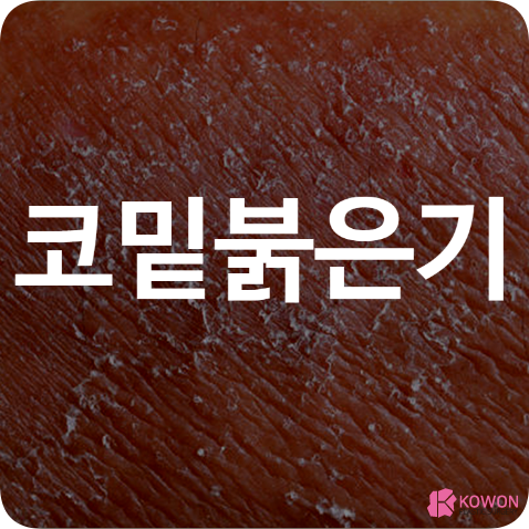 코밑 붉은기 생기는 이유 헐었을때 해결하는 방법 관리
